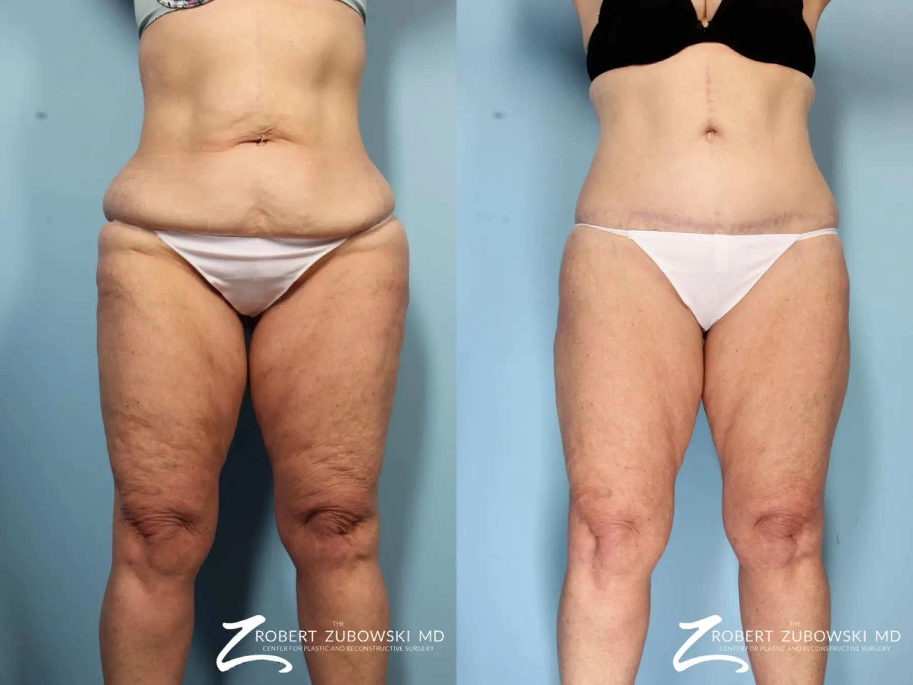 Body Lift Before & After Gallery: Patient 7