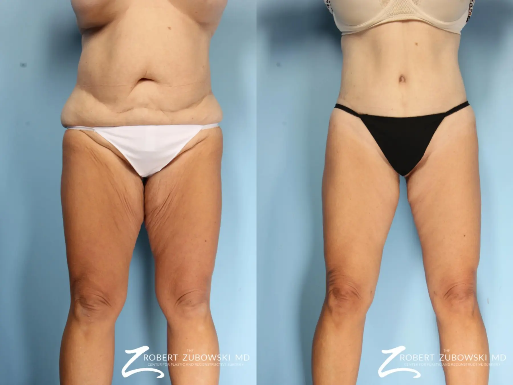 All About The Body Lift Procedure: Costs, Candidacy & More