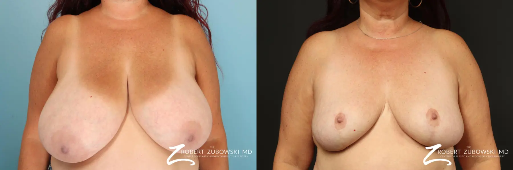 Breast Reduction: Patient 32 - Before and After  