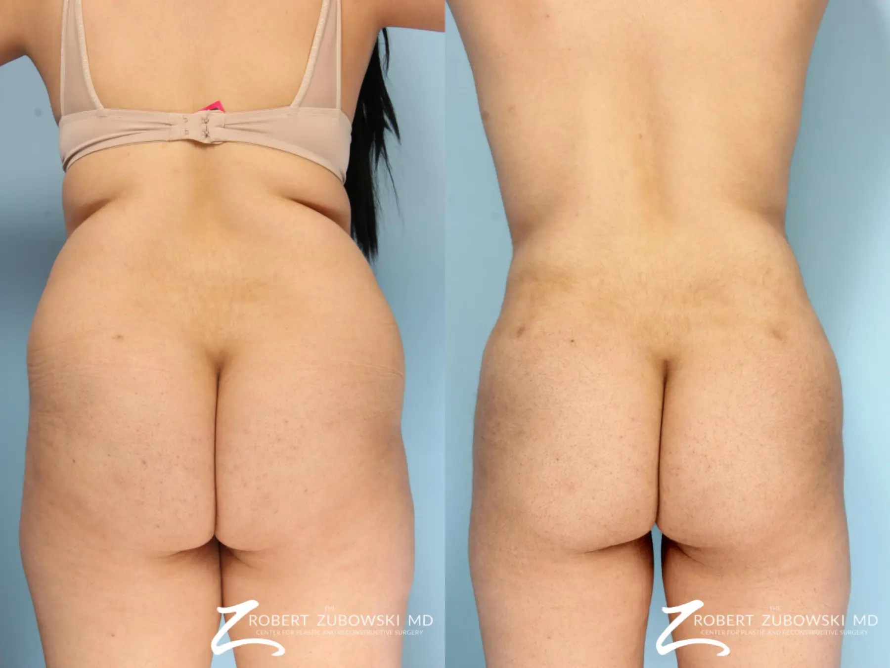 Butt Augmentation Before & After Gallery: Patient 4