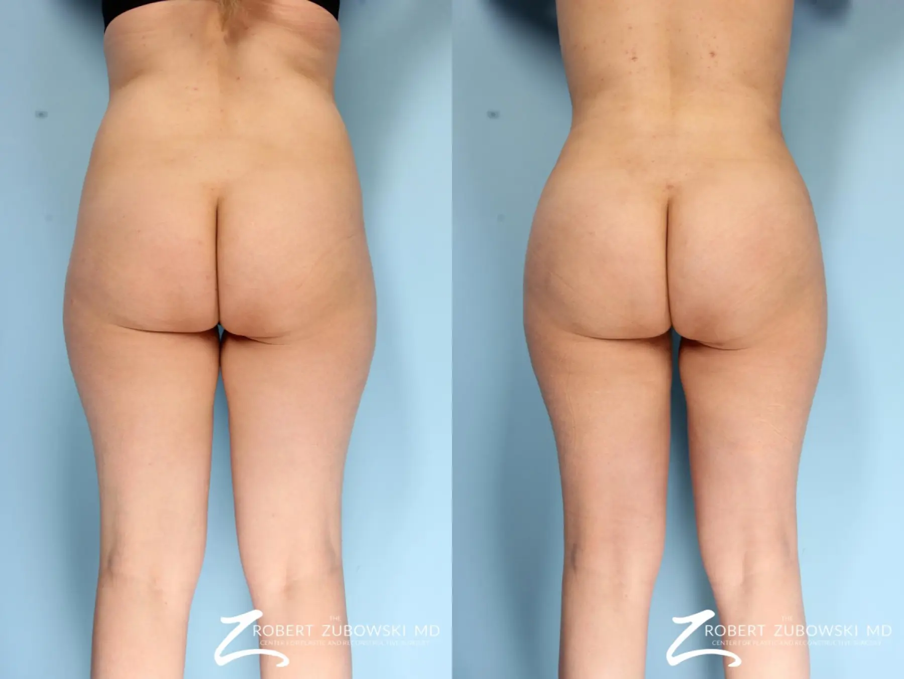 Butt Augmentation Before & After Gallery: Patient 3