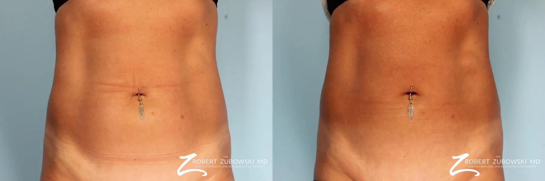 CoolSculpting Paramus Nonsurgical Fat Removal