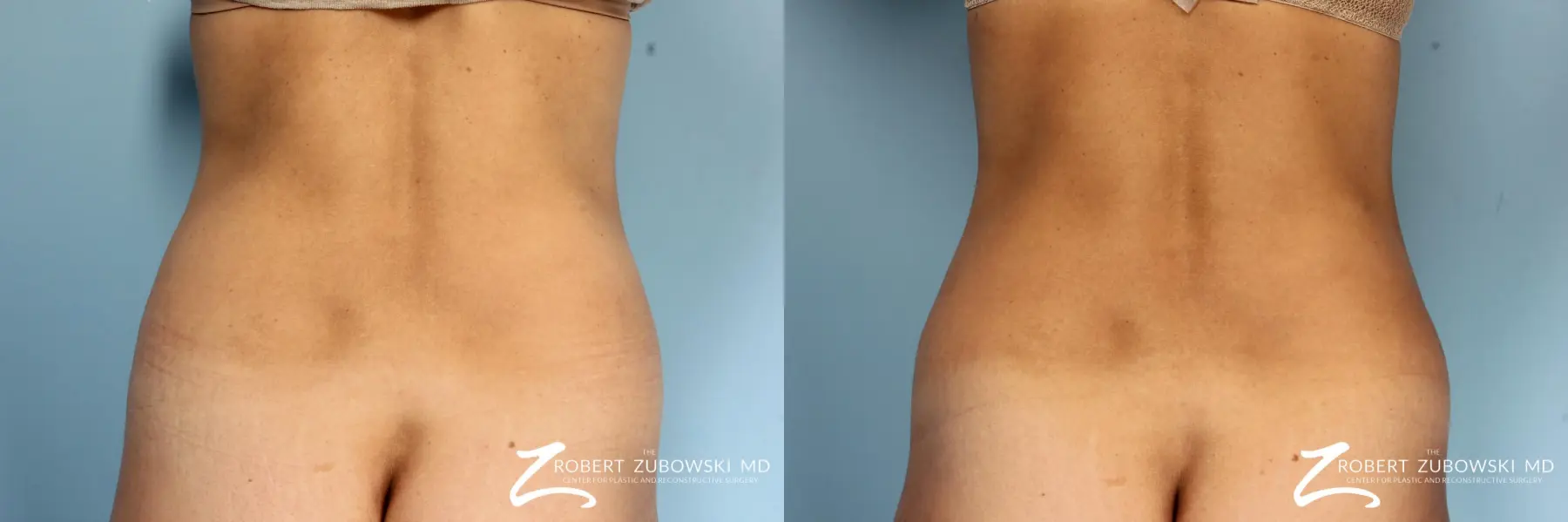 CoolSculpting Paramus Nonsurgical Fat Removal