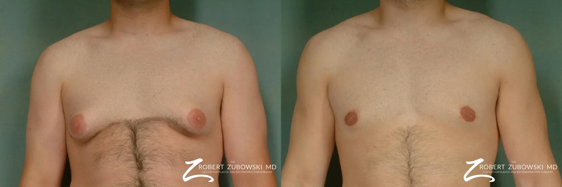 Why Women (and Men) Choose Breast Reduction - North Texas Plastic Surgery