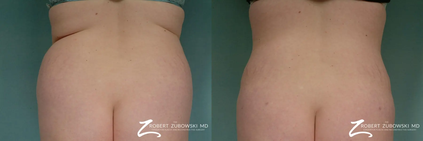 Liposuction of flanks  Care Well Medical Centre