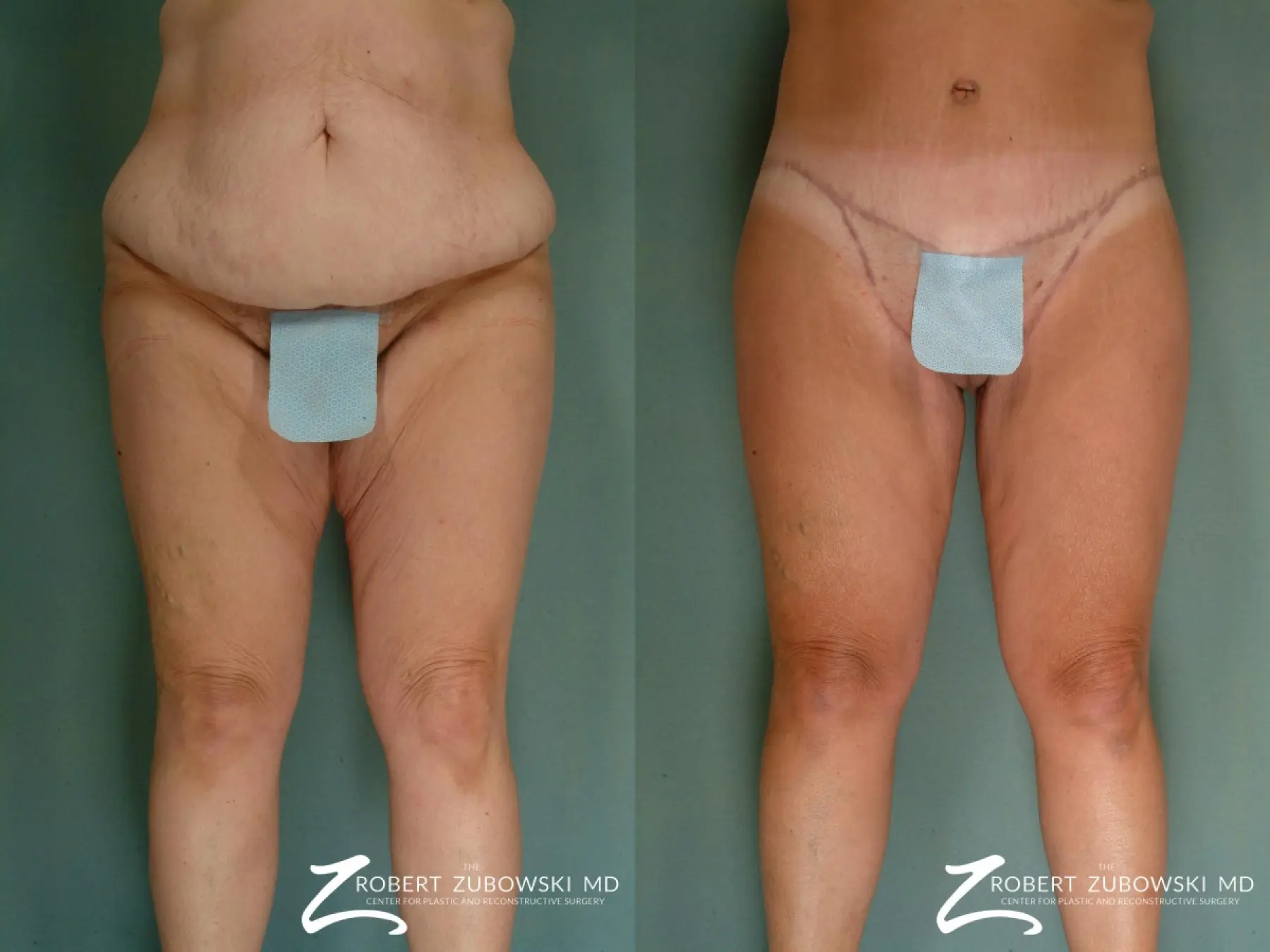 🥇 NYC Thigh Lift (Thighplasty), Manhattan Thigh Plastic Surgery