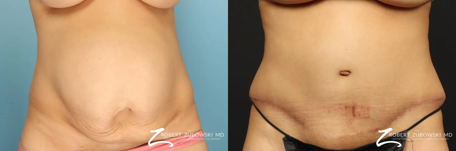 Tummy Tuck, Venus Cosmetic Surgery, Reshape your Body