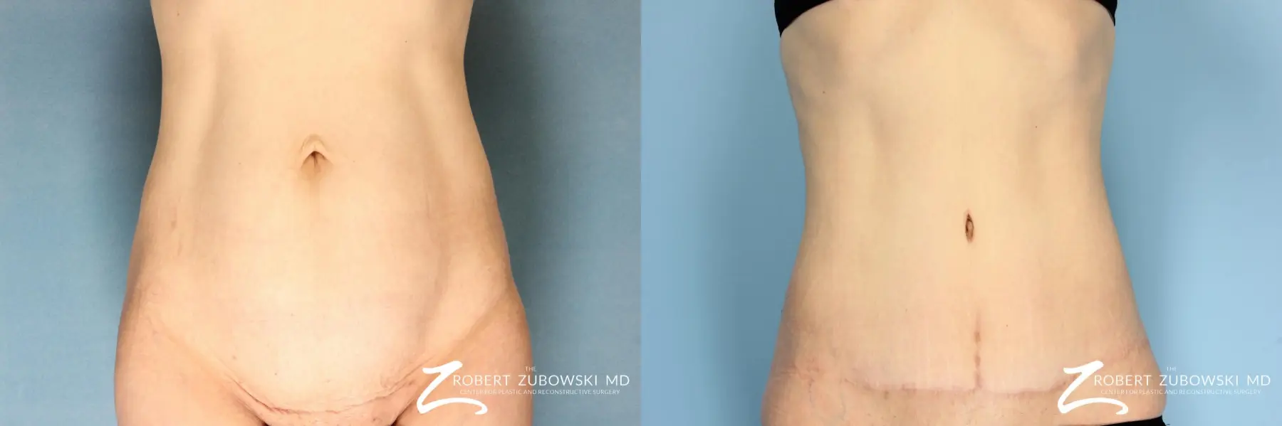 Tummy Tuck Before & After Gallery: Patient 3