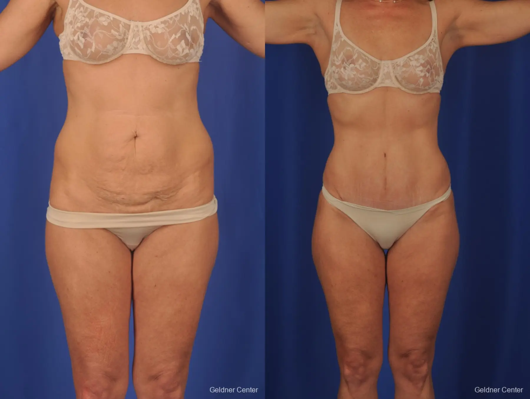 Is Liposuction the Answer to Armpit Fat Removal? - Art Lipo