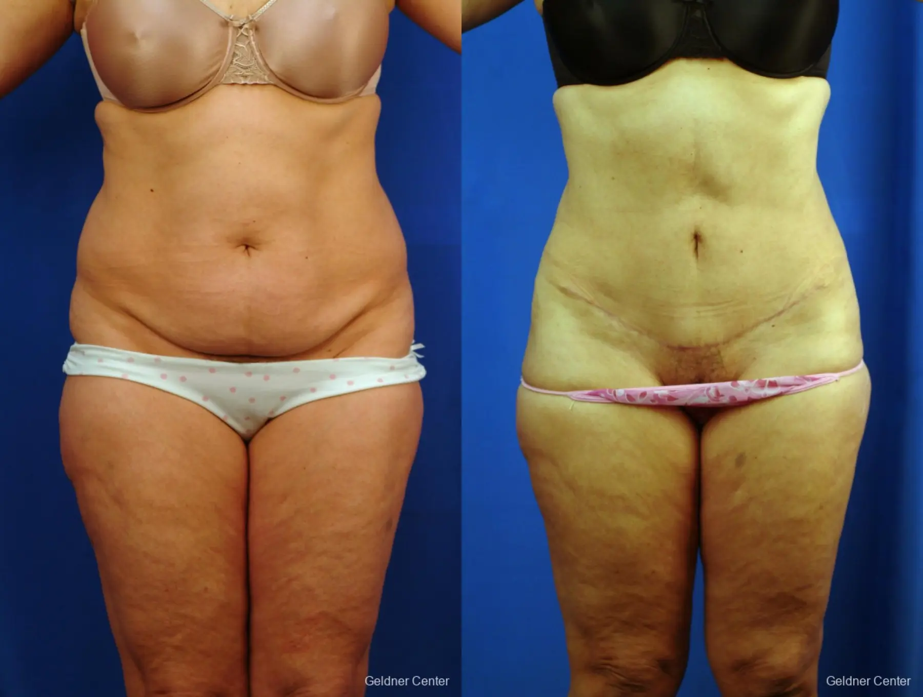 Vaser Liposuction with Abdominal Etching