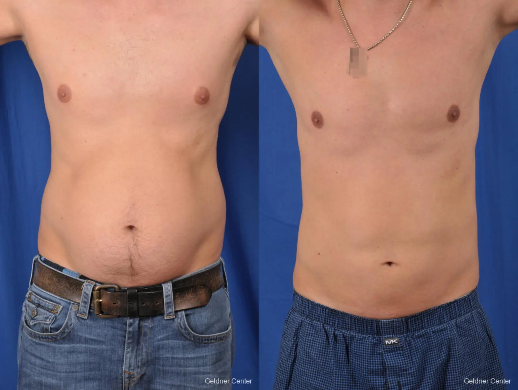 Liposuction For Men Before & After Gallery: Patient 6