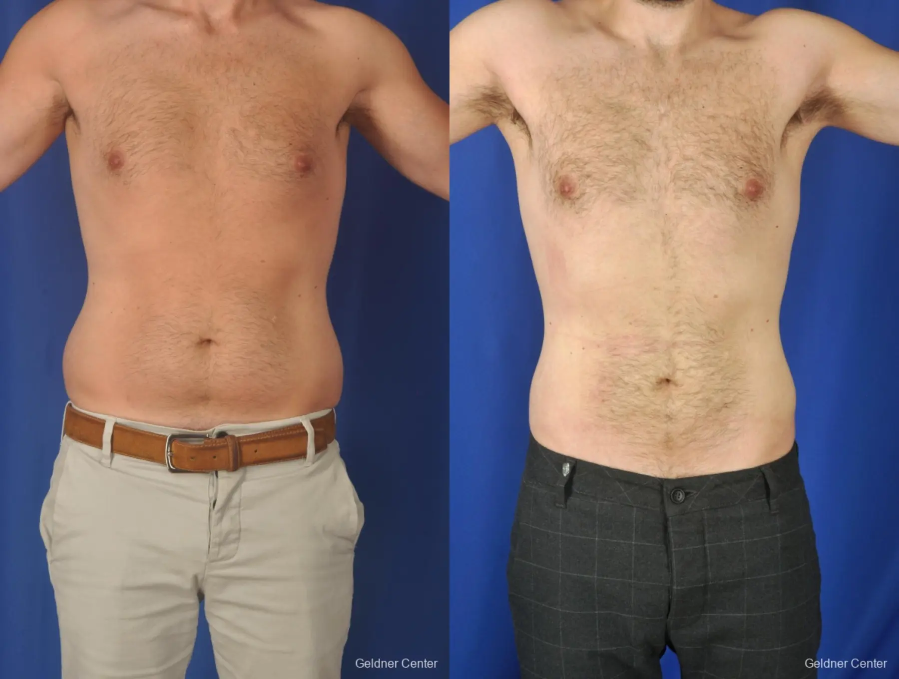 Liposuction Before And After Y98ObArsAc1A Highres.webp