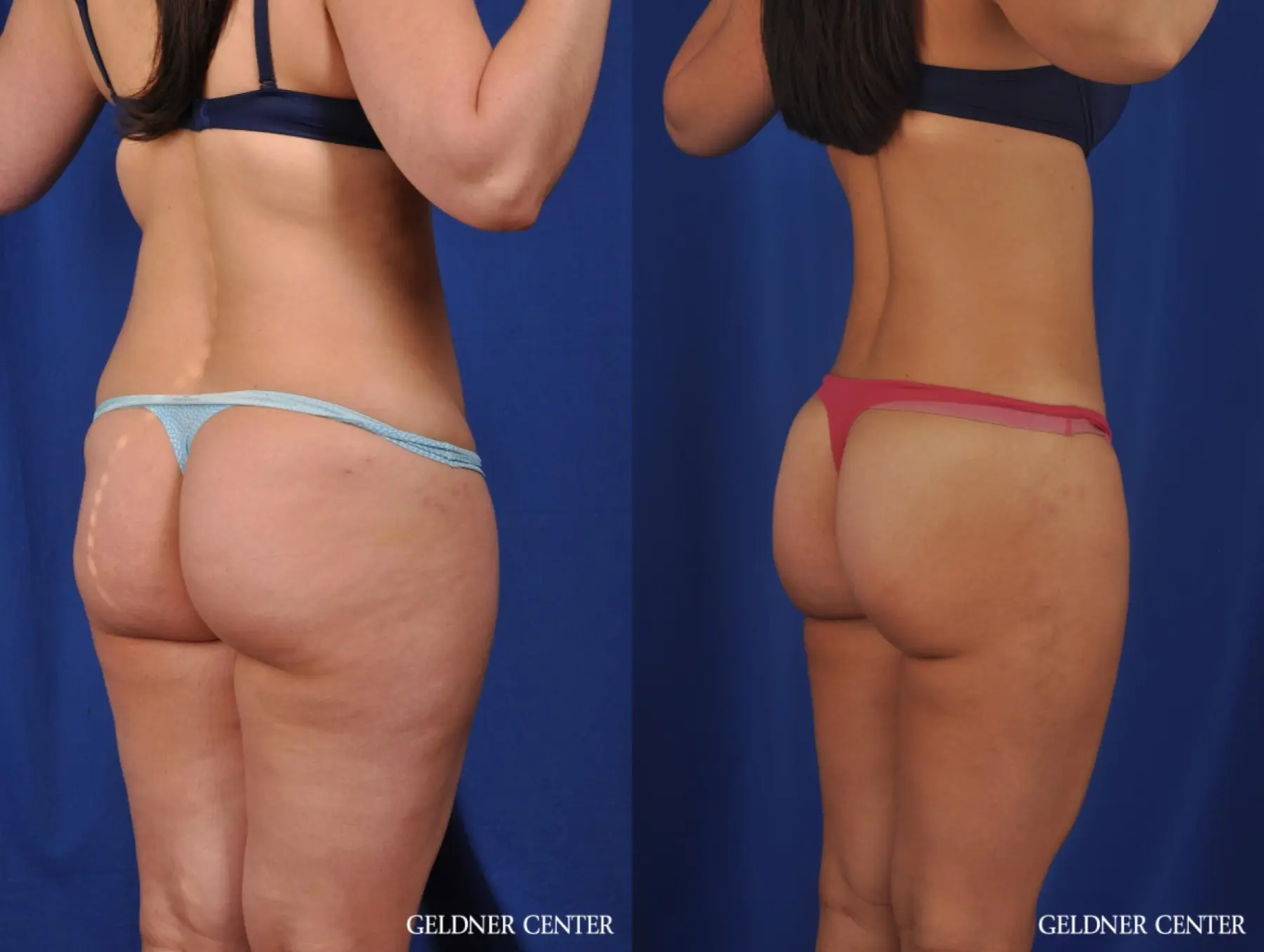 after lipo, after lipo Suppliers and Manufacturers at