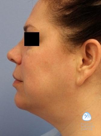 Smart Lipo Laser Facial Sculpting Before and after Photos