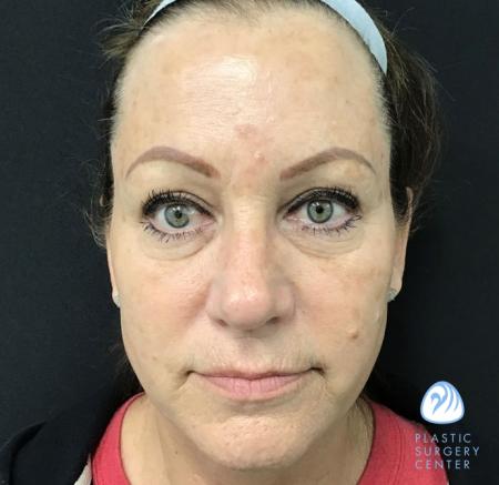 Laser Skin Resurfacing Before & After Gallery