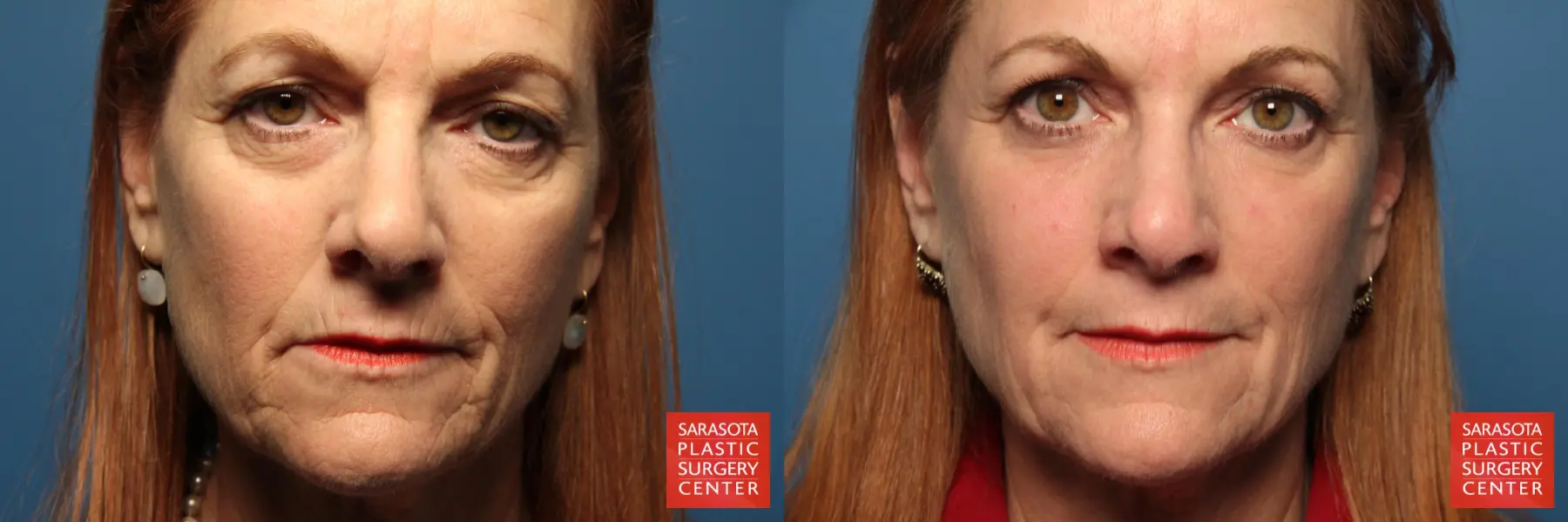 Laser Skin Resurfacing - Face: Patient 5 - Before and After  