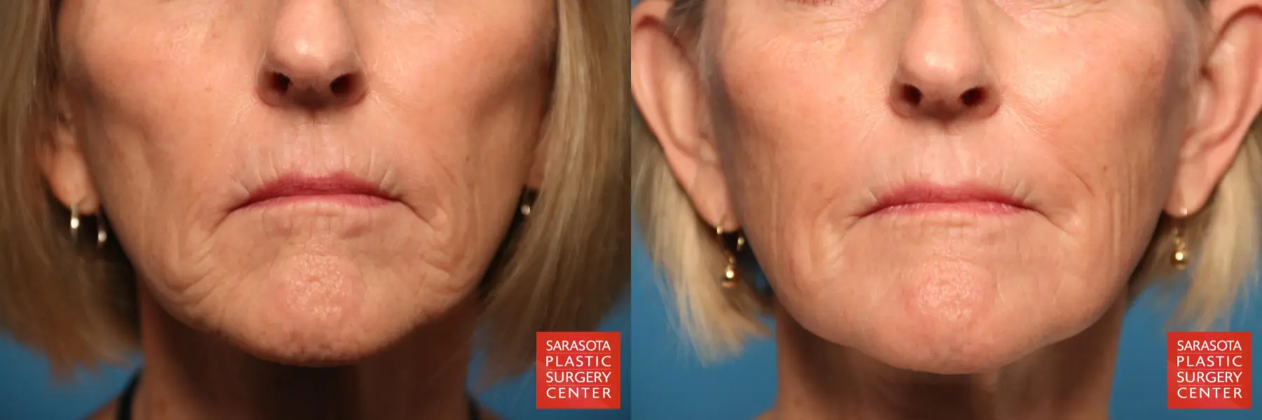 Laser Skin Resurfacing - Face: Patient 9 - Before and After  