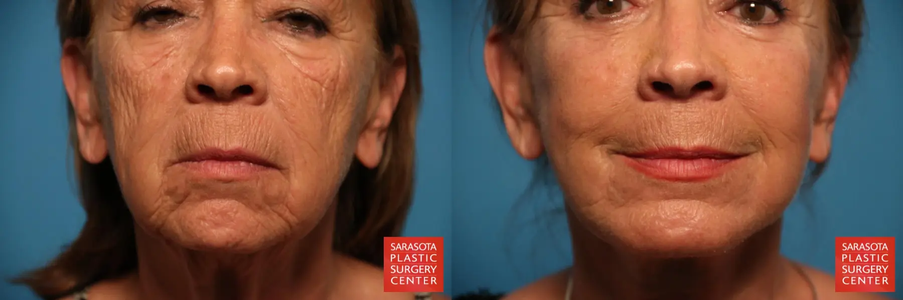 Laser Skin Resurfacing - Face: Patient 6 - Before and After  