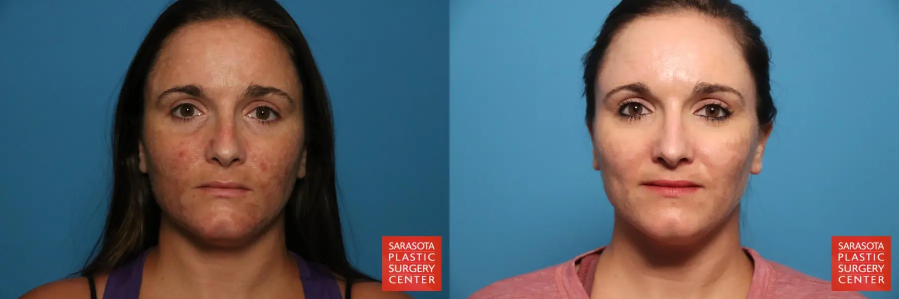 Laser Skin Resurfacing - Face: Patient 10 - Before and After  