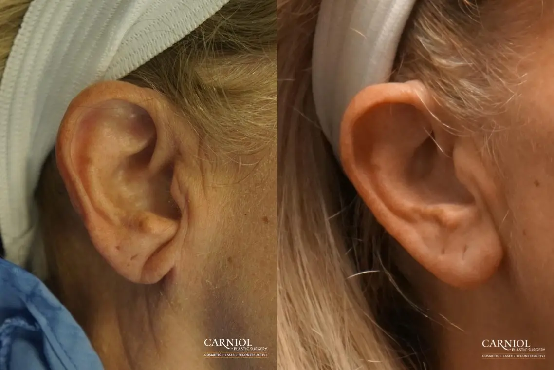 Earlobe Surgery: Patient 3 - Before and After  