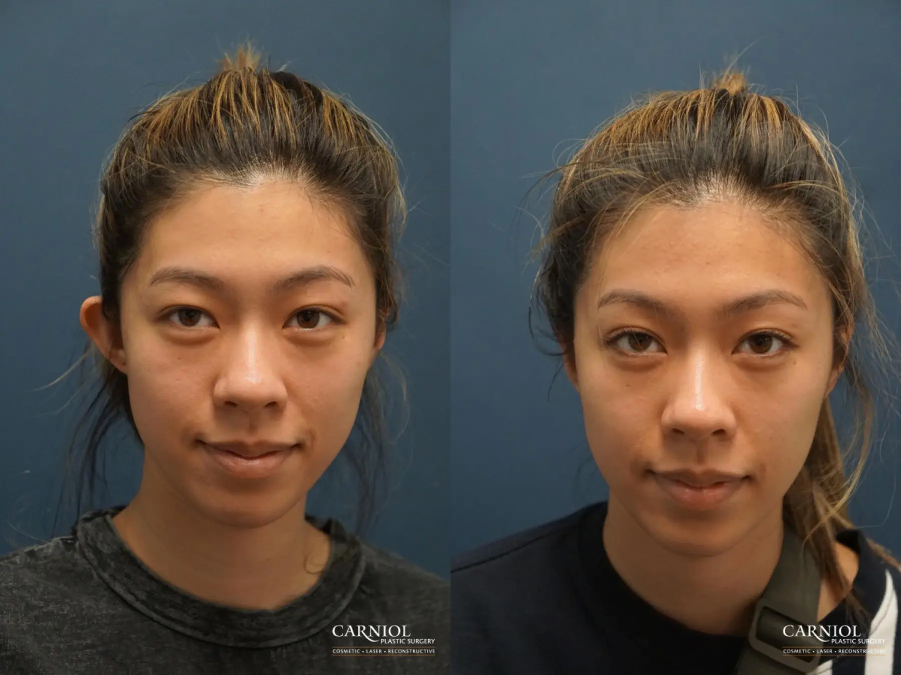 no scar otoplasty - Before and After