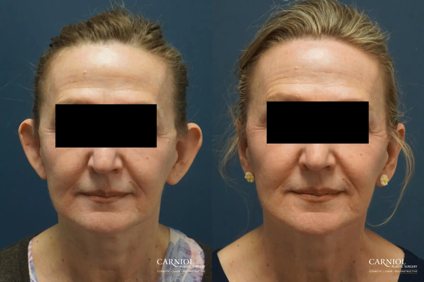 Otoplasty: Patient 2 - Before and After  