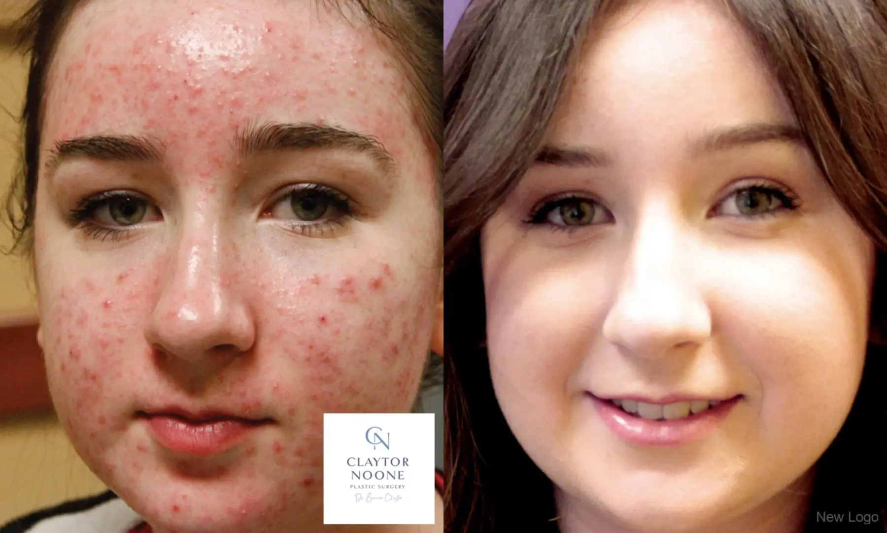 Acne Rejuvenation: Patient 1 - Before and After  