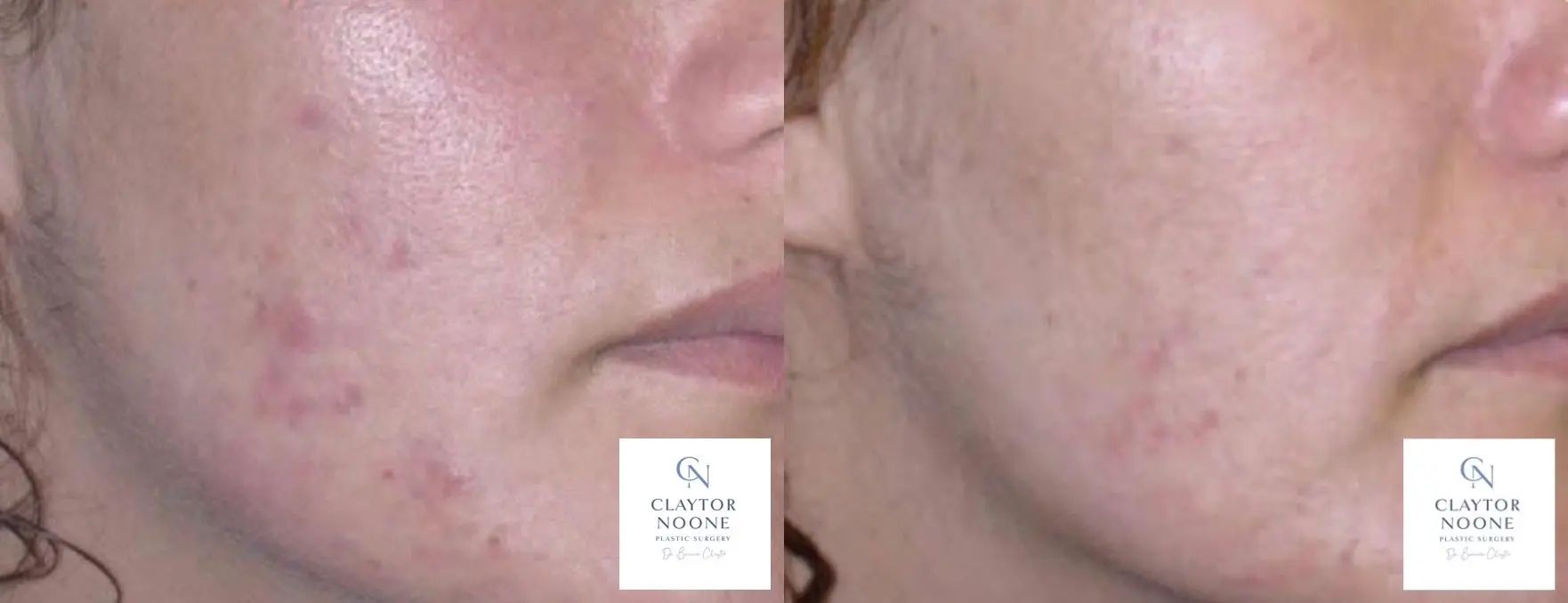 Acne Scars: Patient 1 - Before and After  