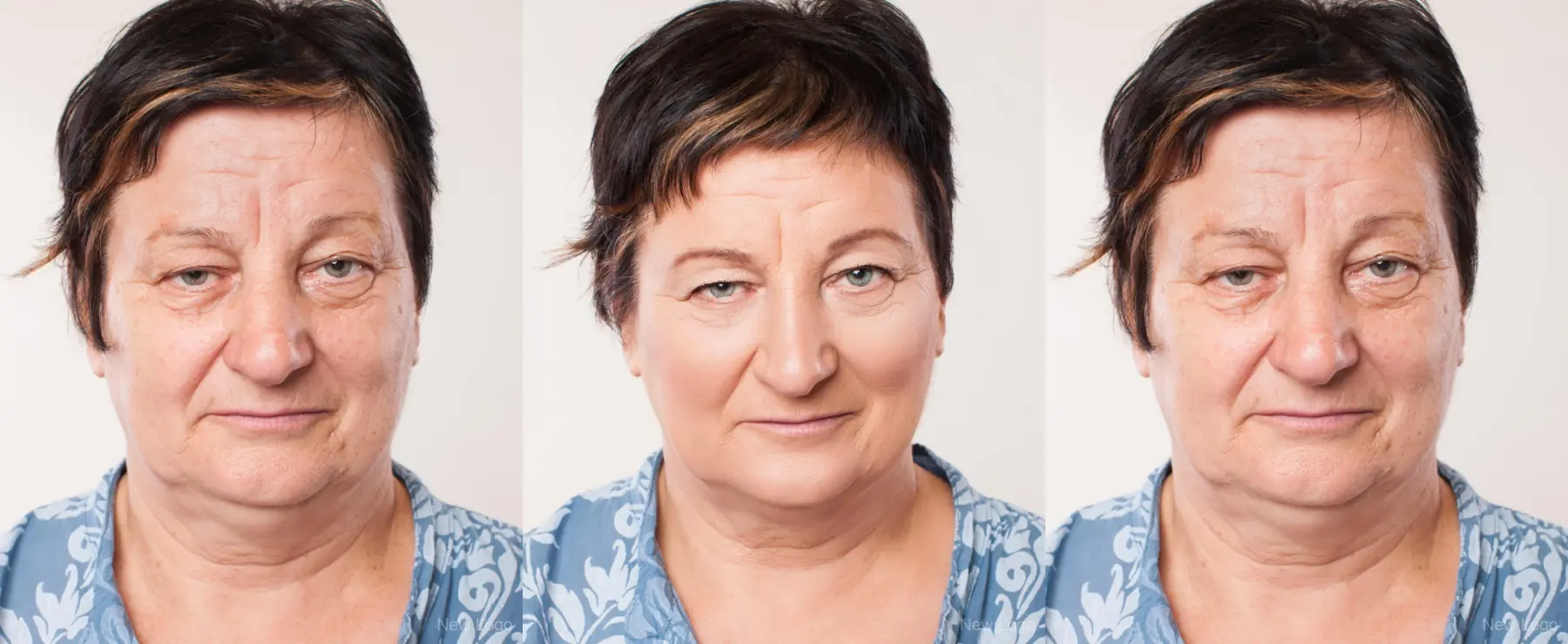 Blepharoplasty: Patient 1 - Before and After  