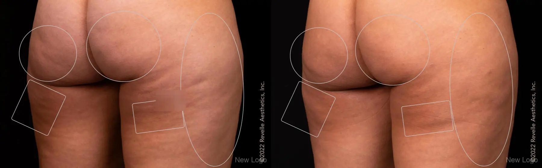 Body Lift: Patient 1 - Before and After  