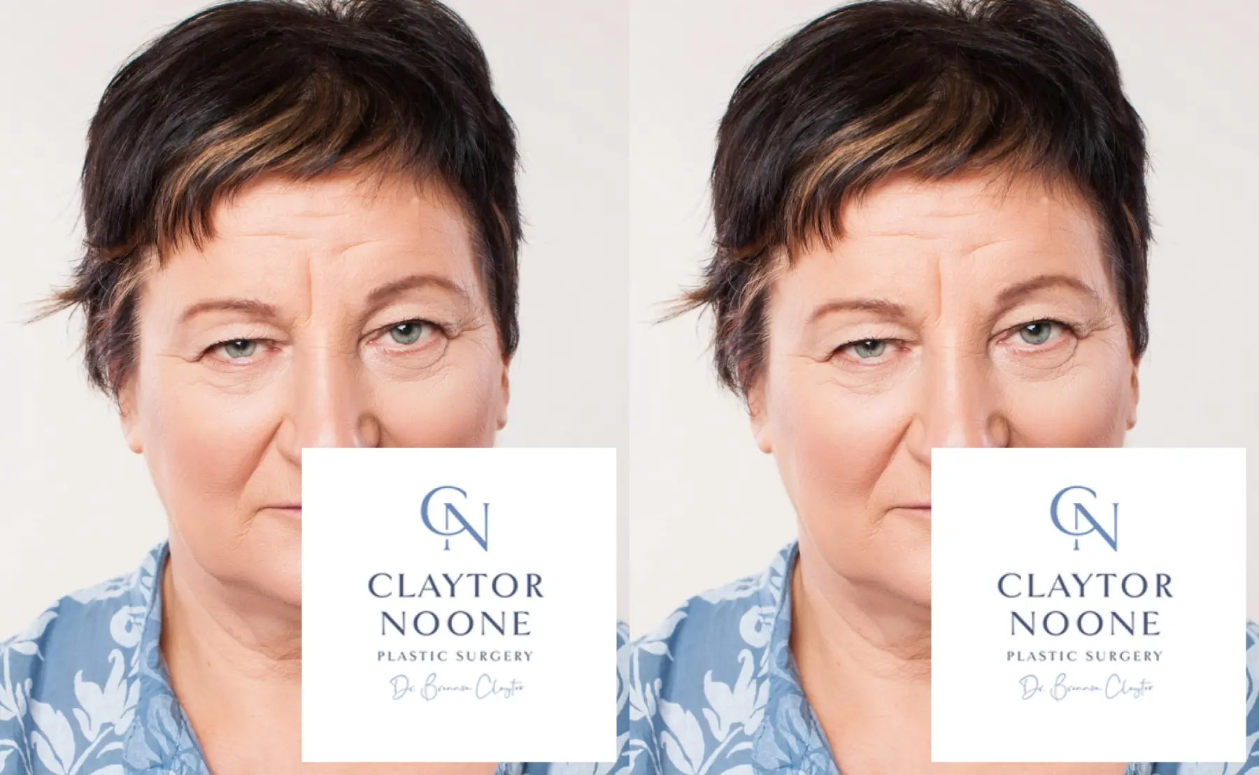 BOTOX® Cosmetic: Patient 8 - Before and After  