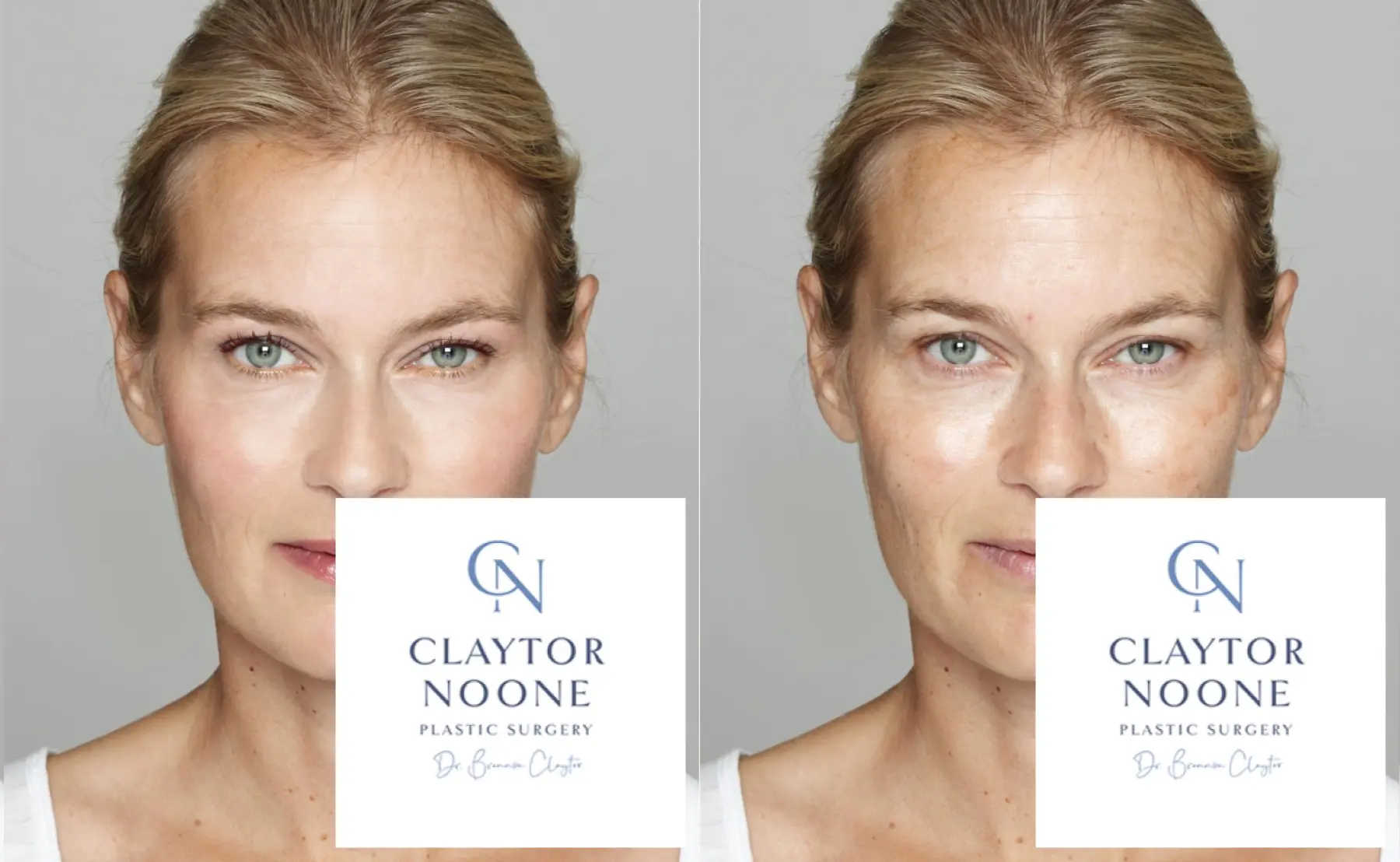 BOTOX® Cosmetic: Patient 6 - Before and After  