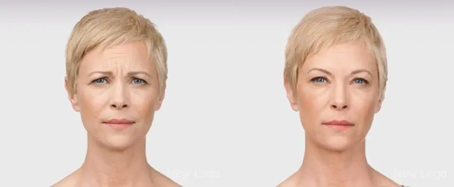 BOTOX® Cosmetic: Patient 2 - Before and After  