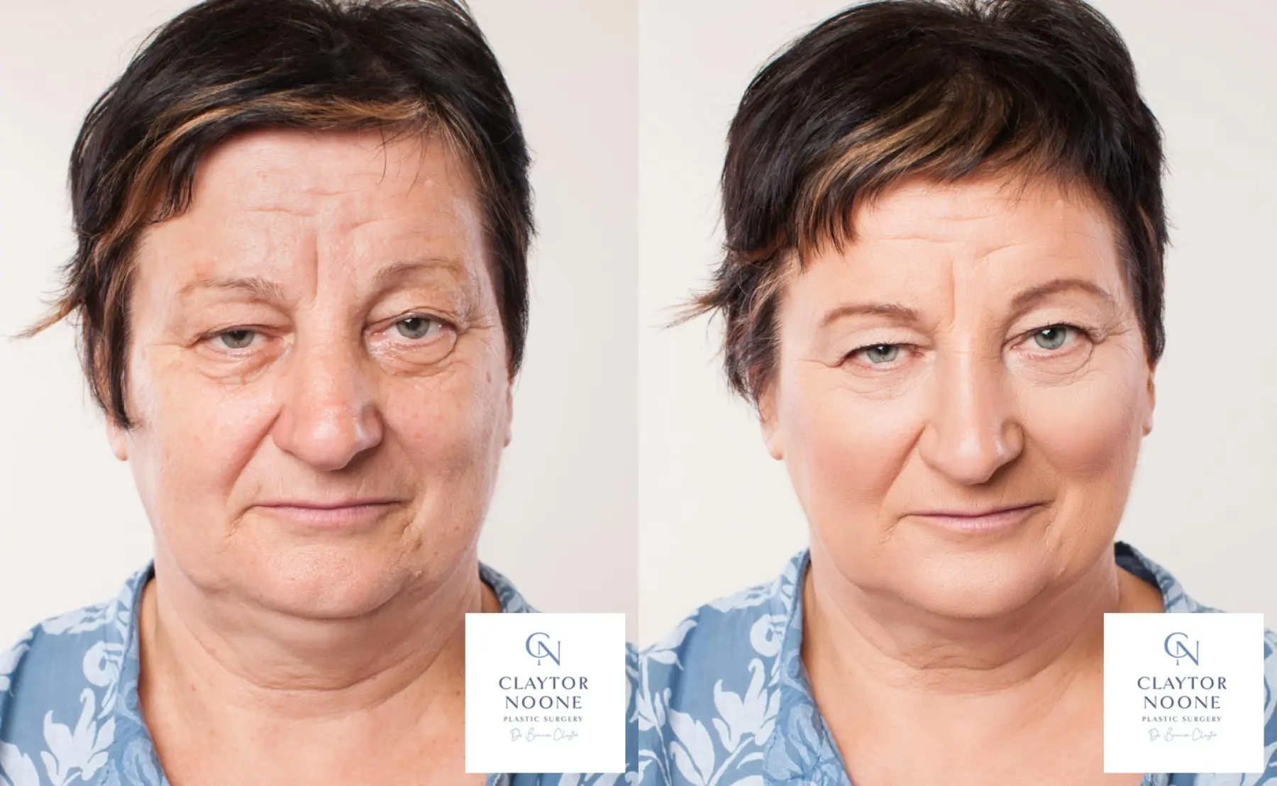 BOTOX® Cosmetic: Patient 3 - Before and After  