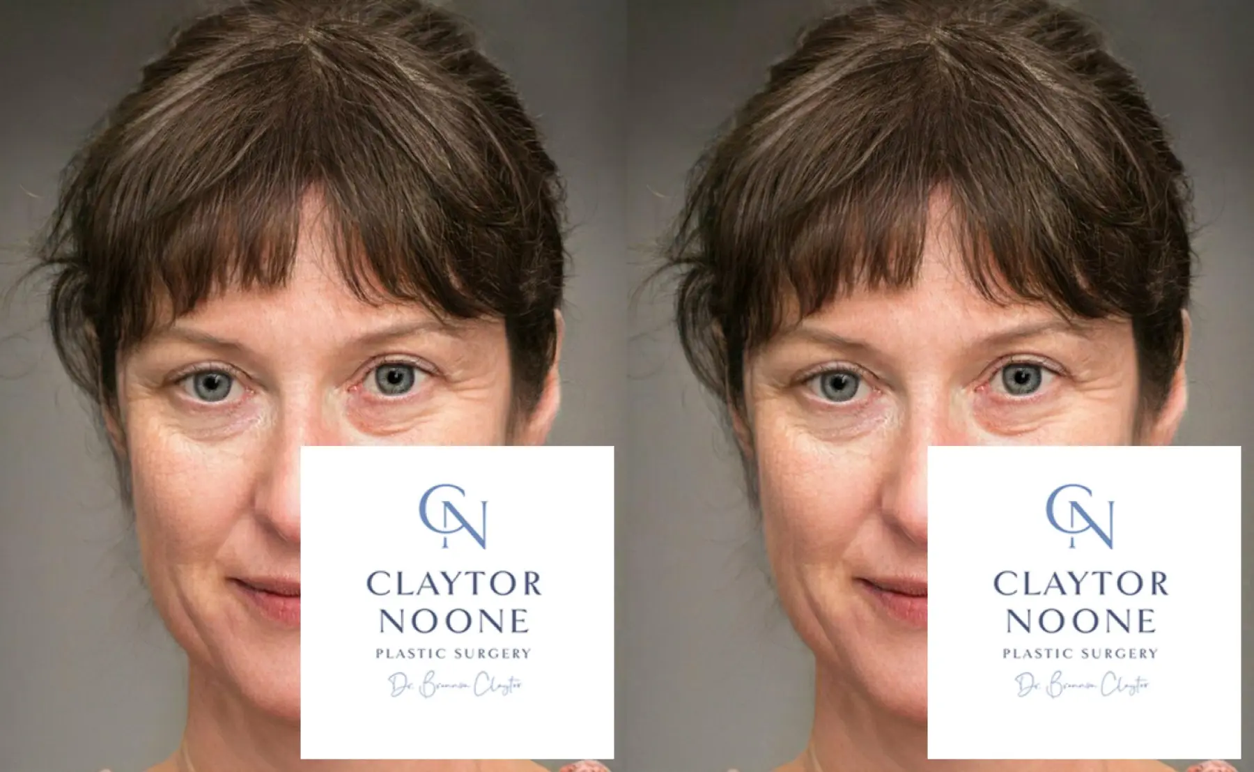 BOTOX® Cosmetic: Patient 7 - Before and After  