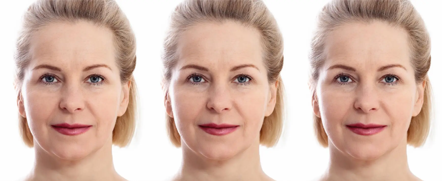 BOTOX® Cosmetic: Patient 9 - Before and After  