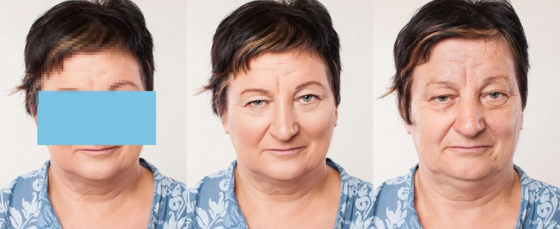 BOTOX® Cosmetic: Patient 1 - Before and After  