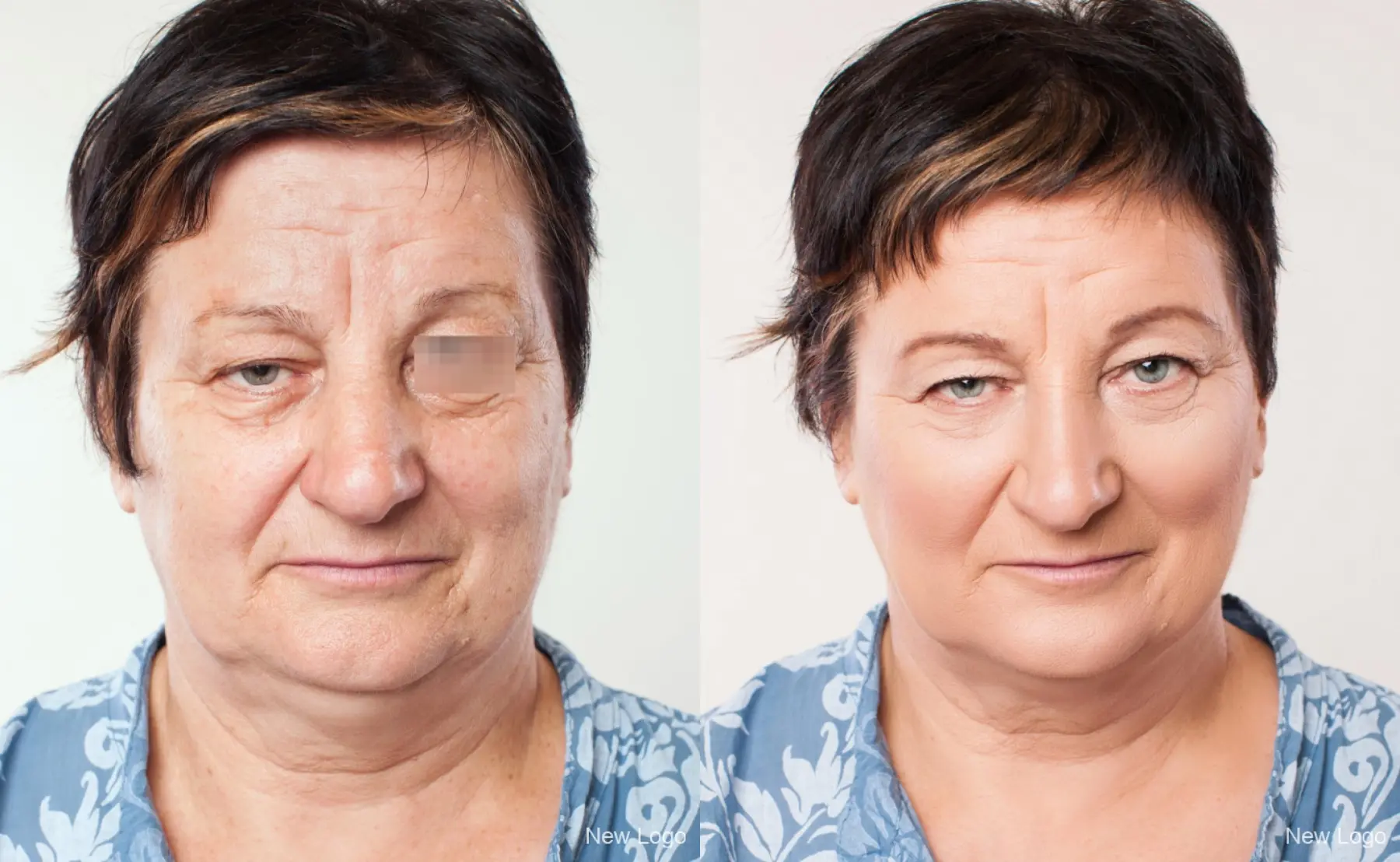 BOTOX® Cosmetic: Patient 4 - Before and After  