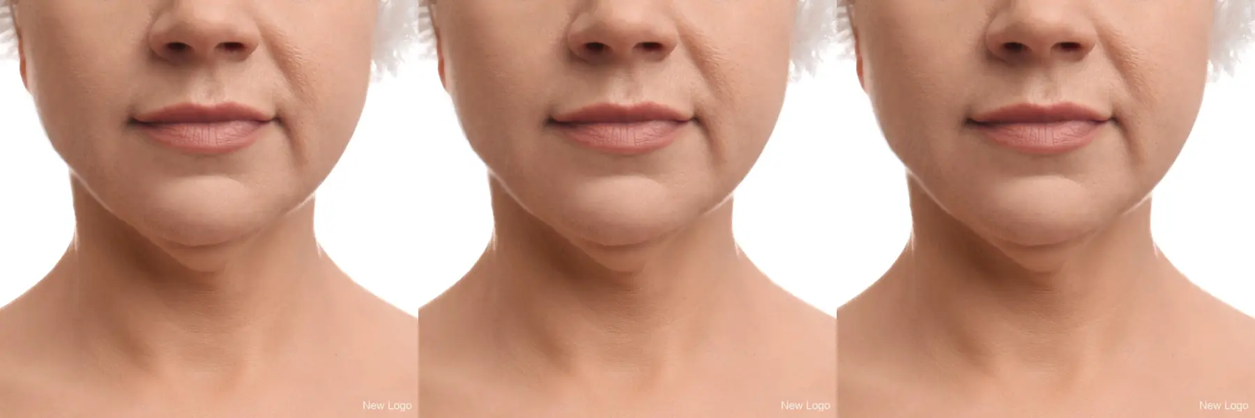 Chemical Peel: Patient 1 - Before and After  