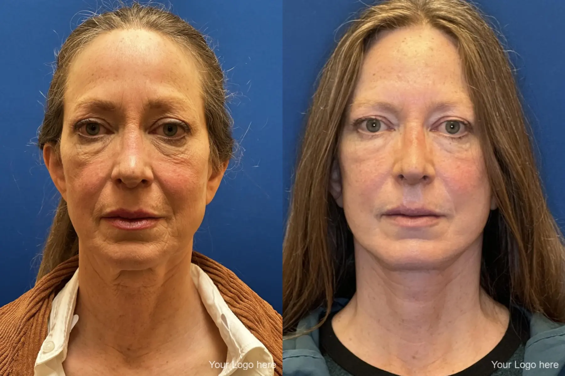Eyelid Lift: Patient 1 - Before and After  