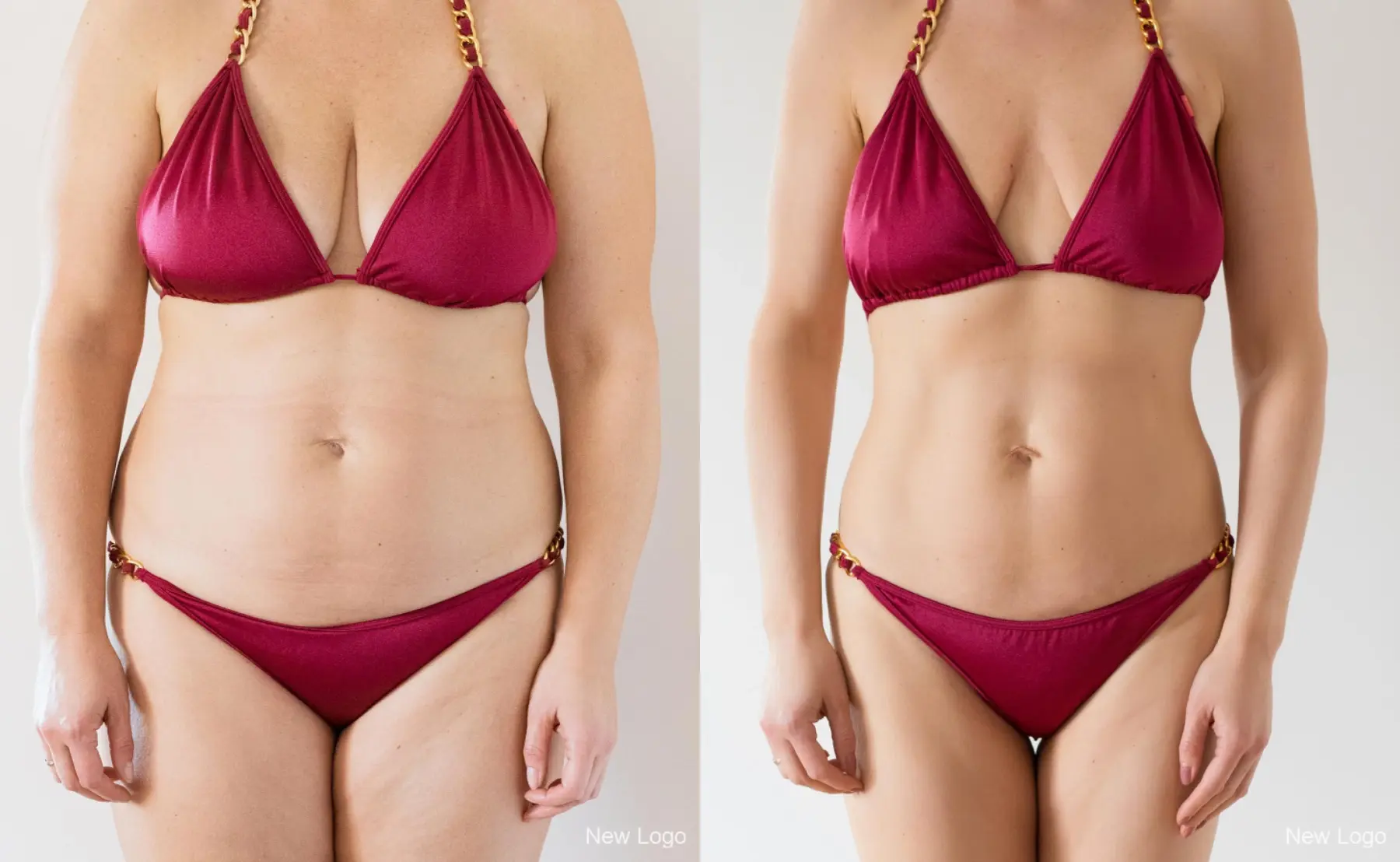 Liposuction: Patient 2 - Before and After  