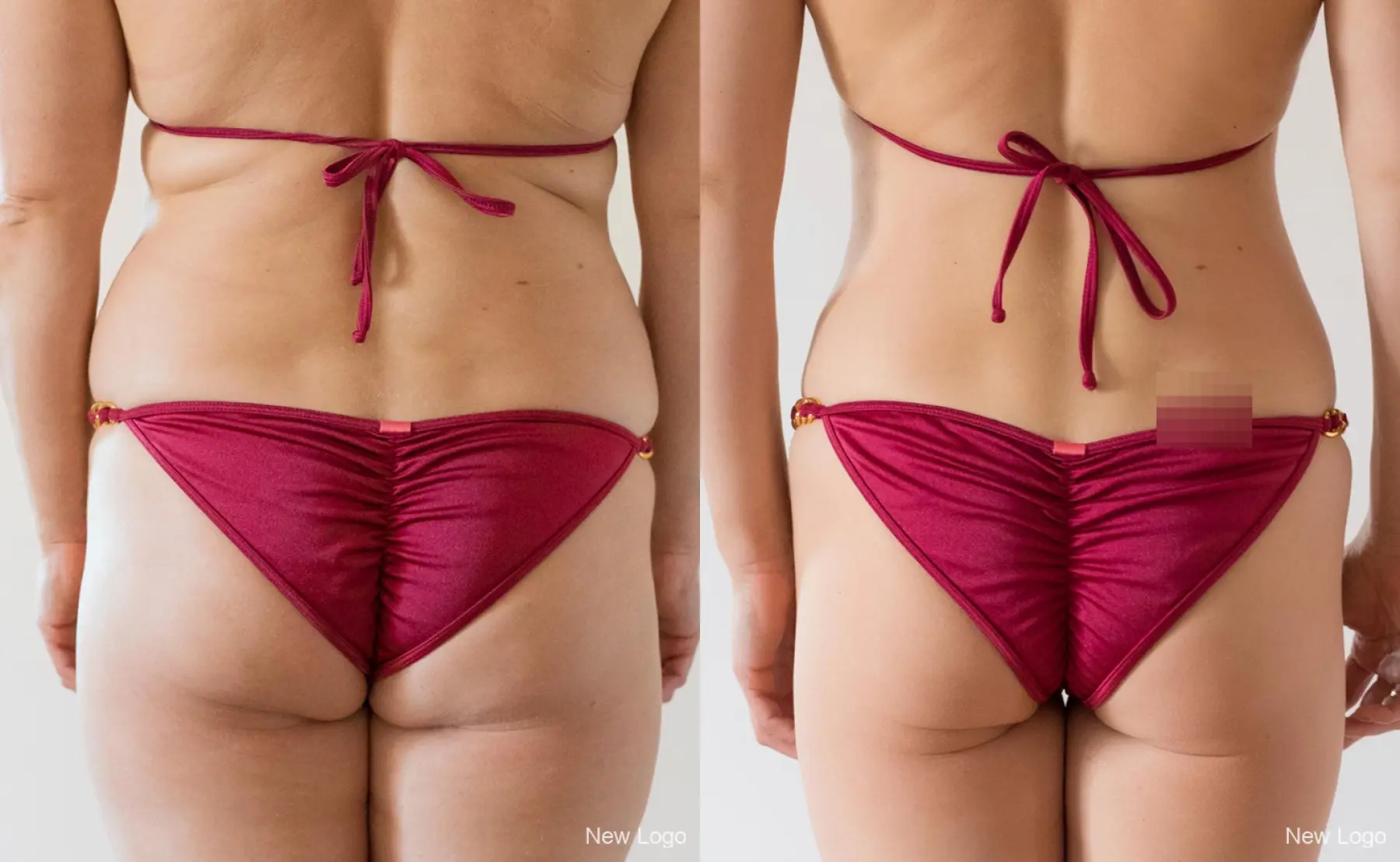 Liposuction: Patient 1 - Before and After  