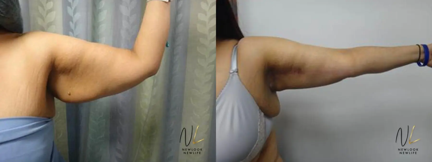 Arm Lift: Patient 4 - Before and After 1