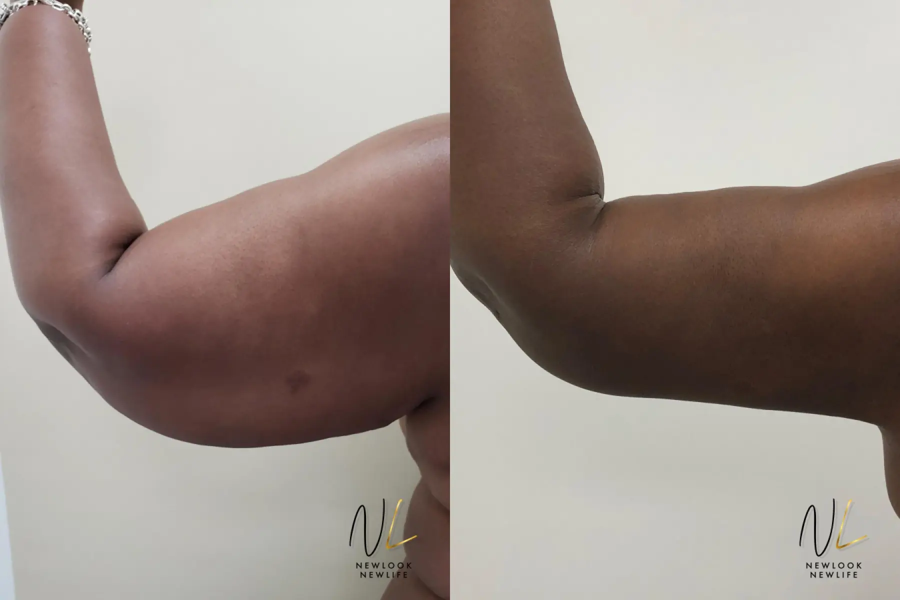 Arm Lift: Patient 9 - Before and After  