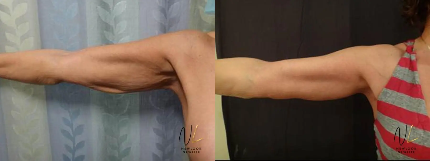 Arm Lift: Patient 8 - Before and After 1