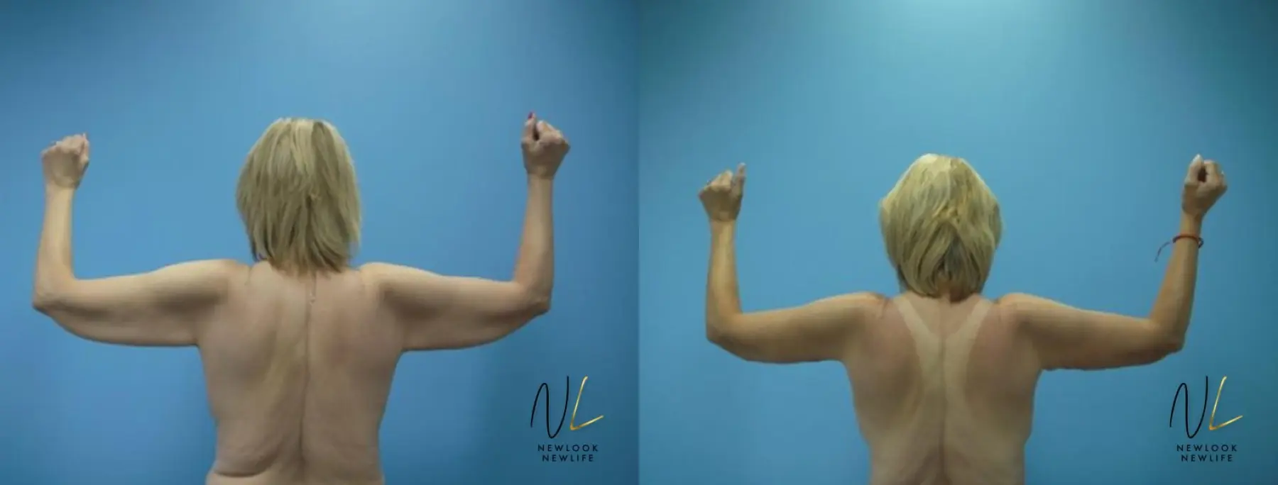 Arm Lift: Patient 7 - Before and After 1