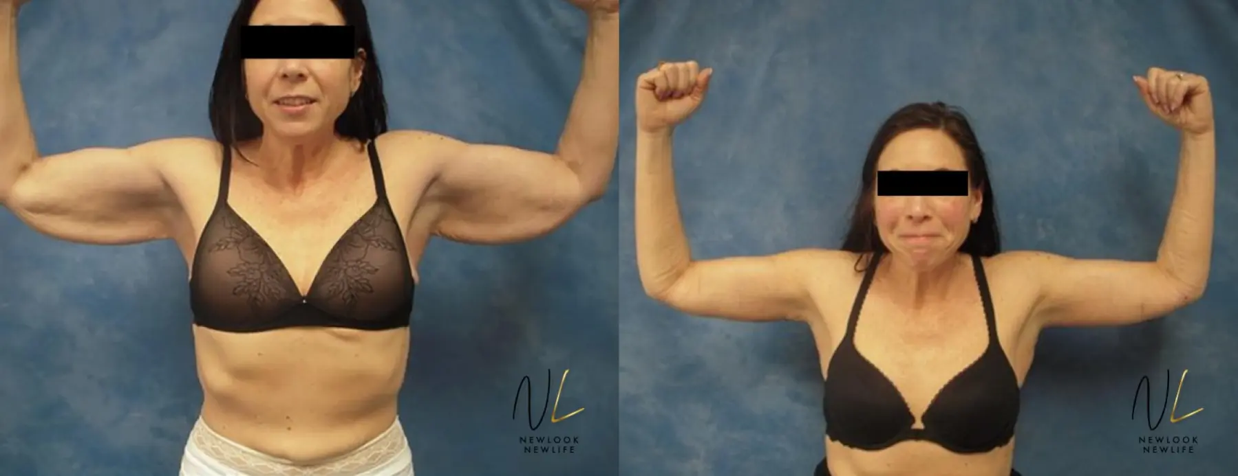 Arm Lift: Patient 5 - Before and After 1