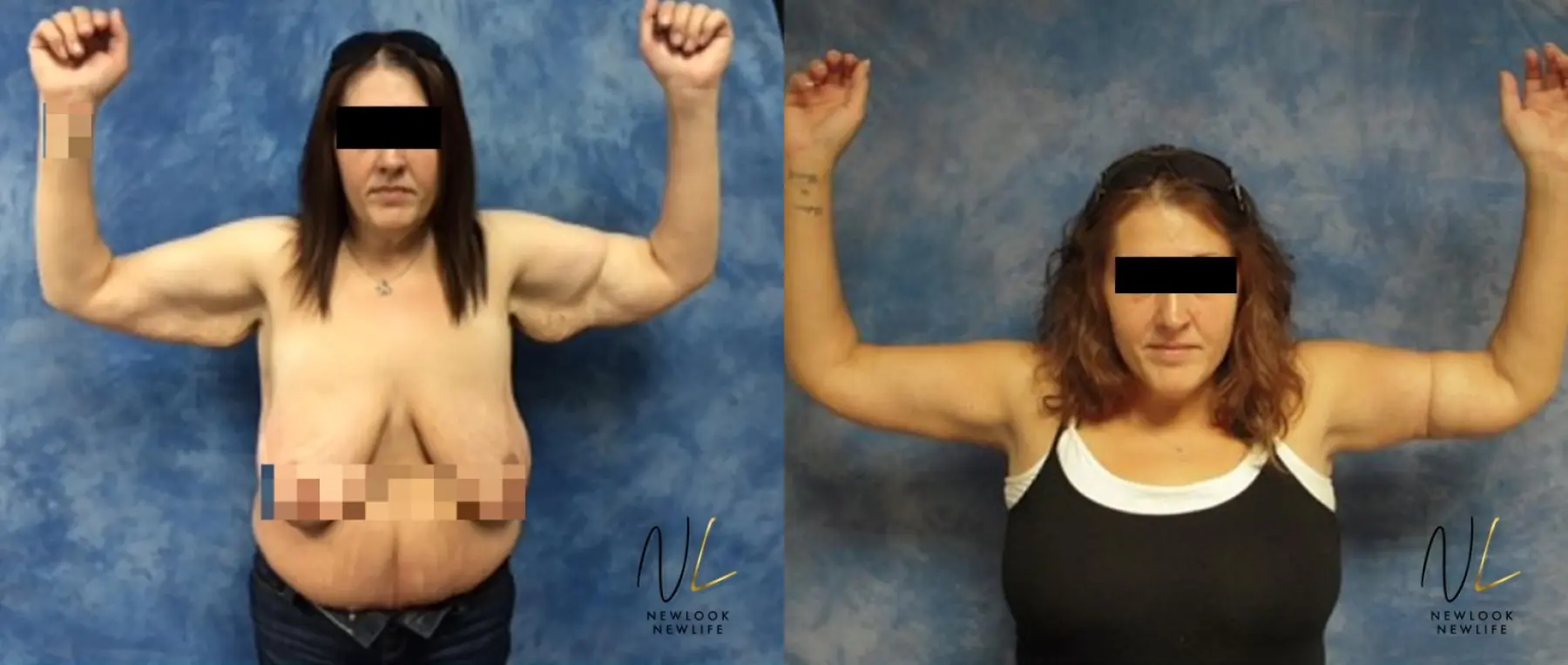 Arm Lift: Patient 10 - Before and After 1