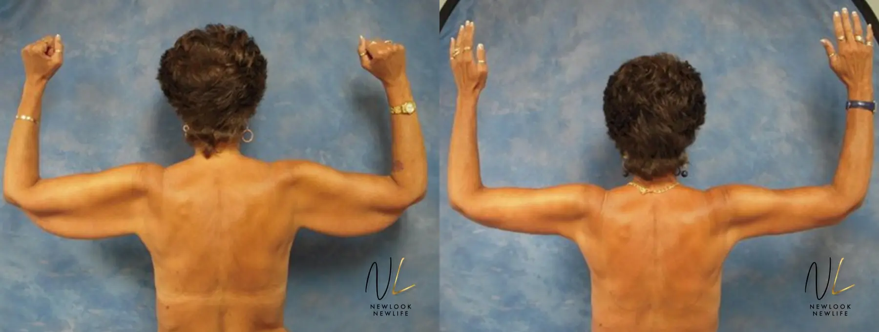 Arm Lift: Patient 3 - Before and After  