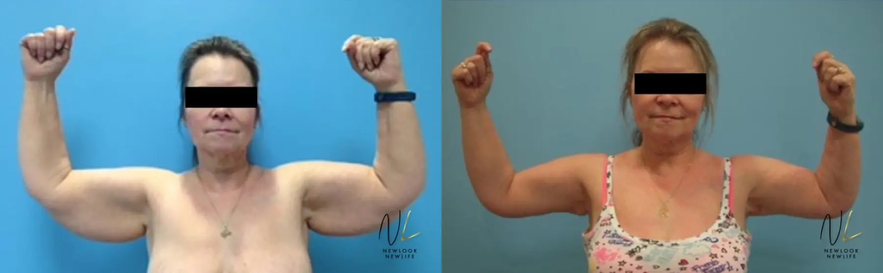 Arm Lift: Patient 6 - Before and After  